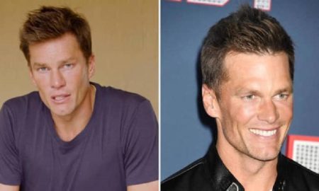 Tom Brady hair transplant rumors.